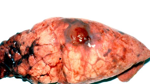 Chonic App lesion in the diaphragmatic lobe with pleuritc tags
