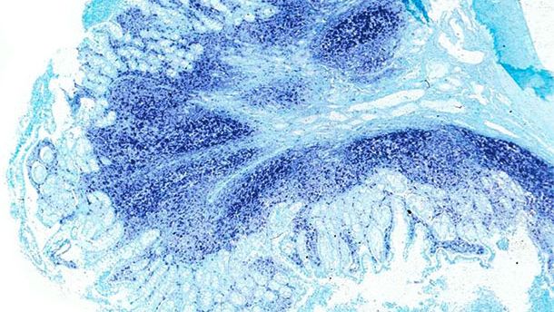 Ileum. The same ileum of the PCV2-systemi disease affected pig displays a massive amount of PCV2 genome at the Peyer&rsquo;s patches and the intestinal mucosa. In situ hybridization to detect PCV2; fast green counterstain.