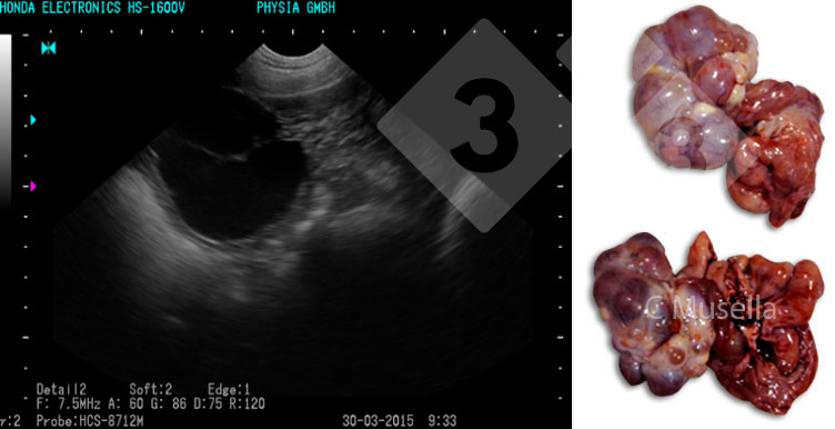 Figure 3. Ovarian policysts.
