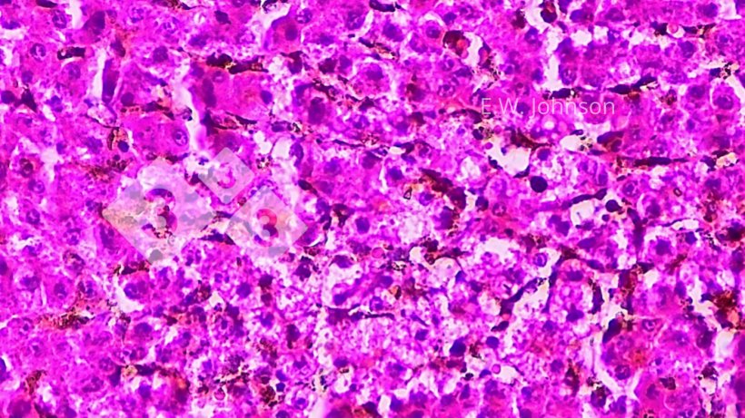 Figure 4. Focal hepatic necrosis with occasional amphophilic intranuclear inclusions in peri-necrotic zone. Liver.
