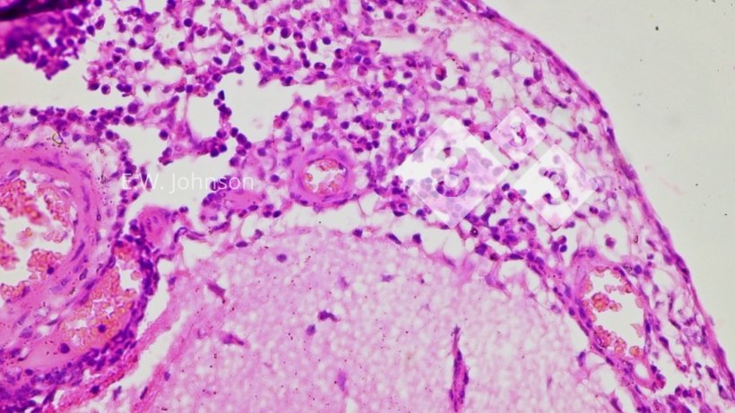 Figure 3. Meningitis with mononuclear cells and a few polymorphonuclear cells. Cerebrum.
