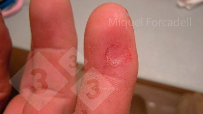 The small, sharp teeth of the piglets can cause these bothersome injuries to the workers' fingers during tooth grinding.